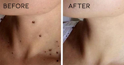 Warts Remover Original Cream